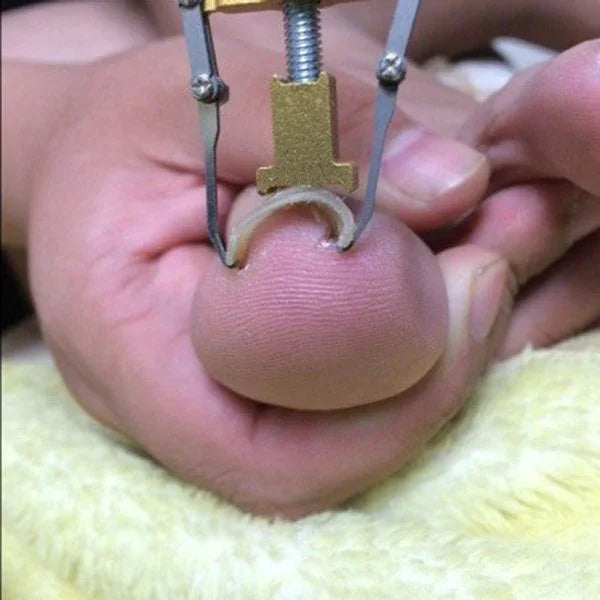 巻き爪ペディキュア フットネイルケアツール 足指用外反母趾矯正器