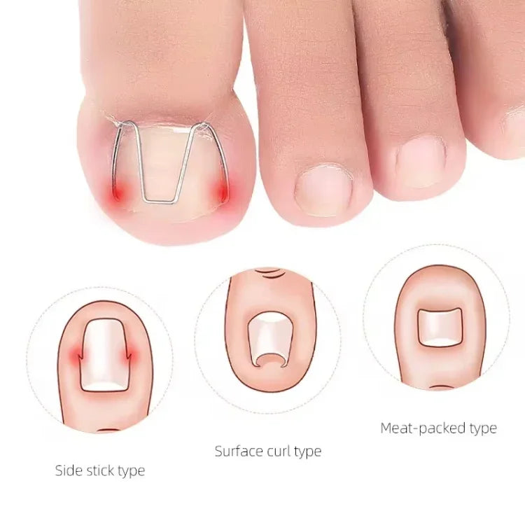 6pcs /Box Ortho Wire Nail Insertion Orthotic Toe Nail Ortho Hooks